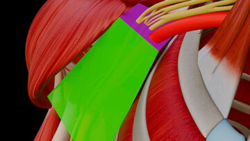 A UL 9 Axilla – Thumbnail