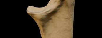 AUL 15 Ulna – Thumbnail