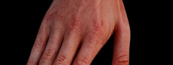 AUL 26 – Hand – Surface Anatomy – Thumbnail