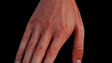 AUL 26 – Hand – Surface Anatomy – Thumbnail